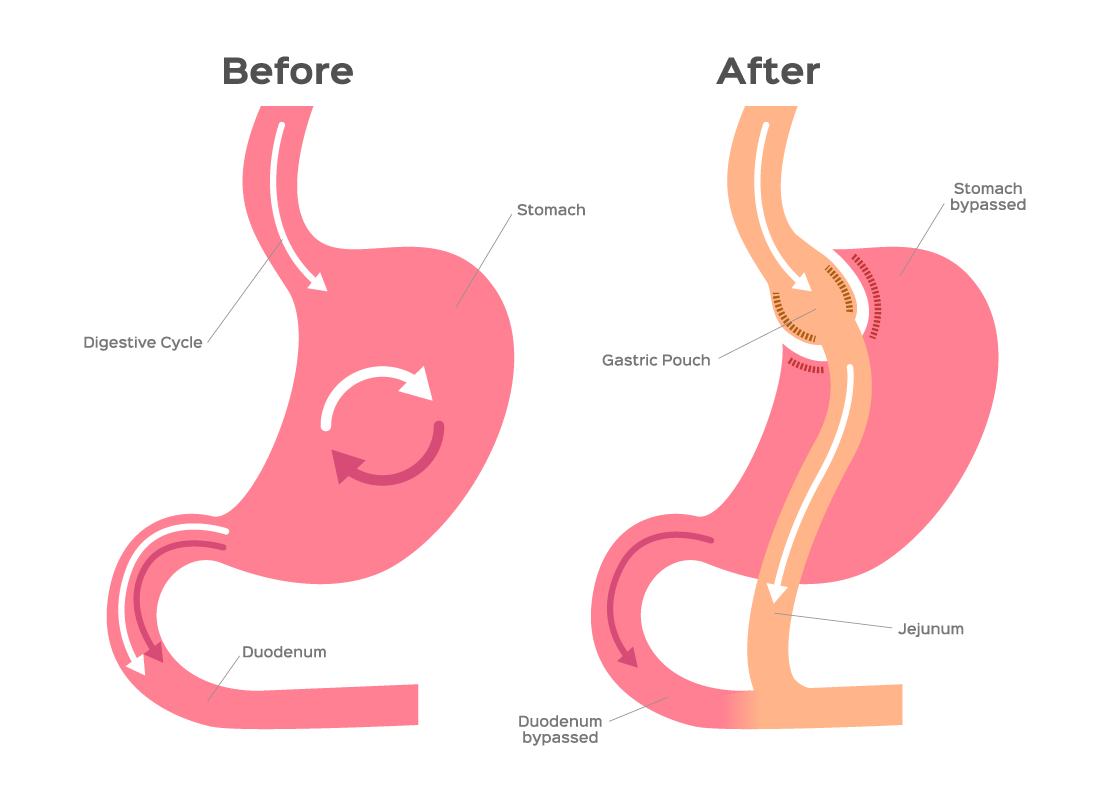 Gastric Bypass Vs Gastric Sleeve Which One Is Right For
