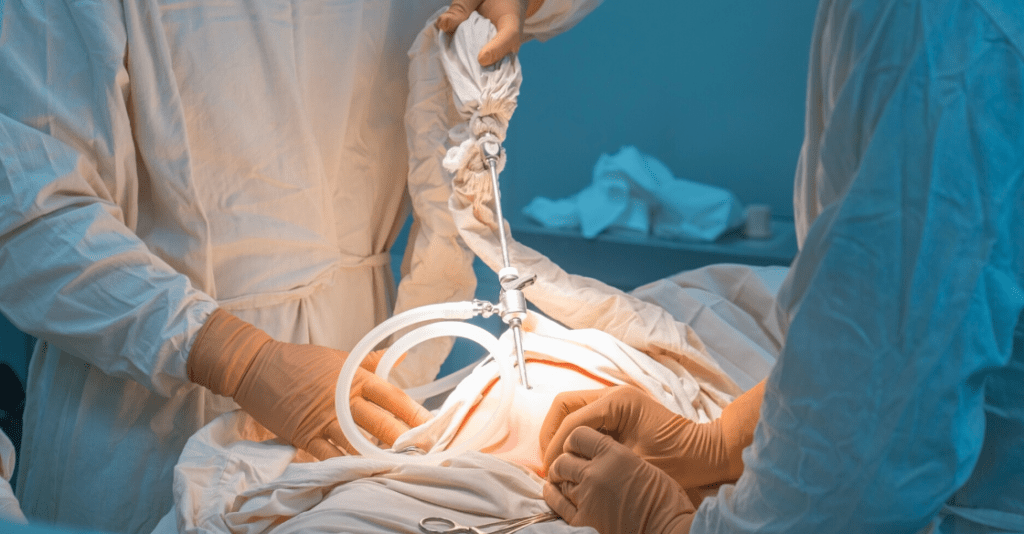 Hiatal Hernia Surgery Questions | Olde Del Mar Surgical