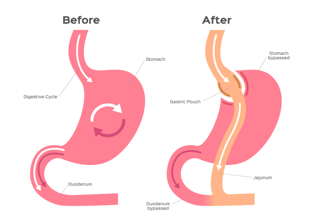 Gastric Bypass vs. Gastric Sleeve: Which One Is Right for You?