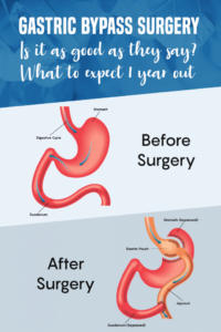 Gastric Bypass Surgery Before and After image