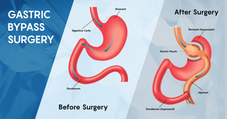 Diagram of before and after gastric bypass surgery
