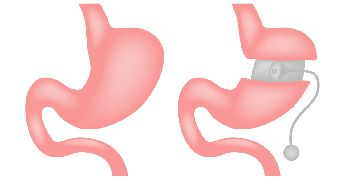 Before and after depiction of a gastric band or lap-band weight loss surgery.