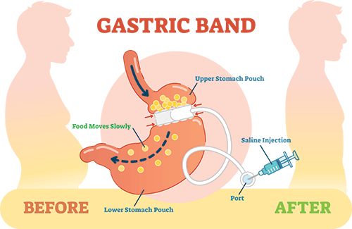 Image of how the gastric band works before and after