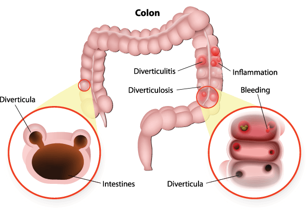 Diagram of a cross section of a colon