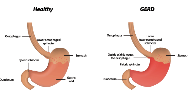 Diagrams of a healthy stomach vs a stomach with GERD