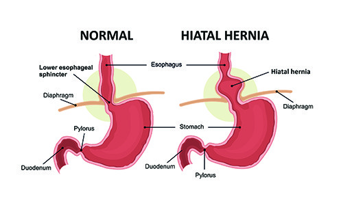 Diagram of a normal stomach and a stomach with hiatal hernia
