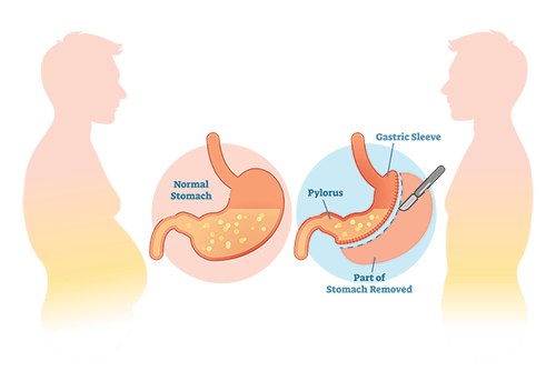 Image of the gastric sleeve process