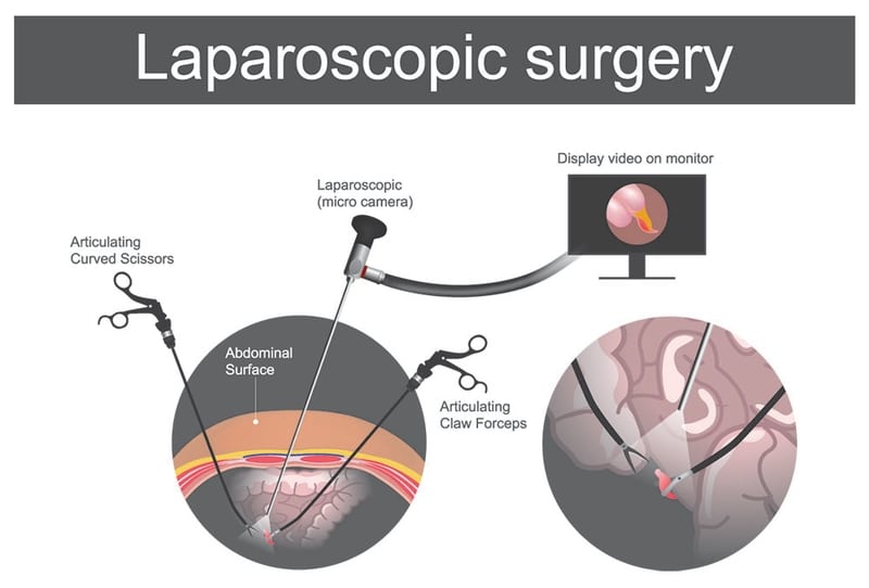 Laparoscopic Surgery Diagram
