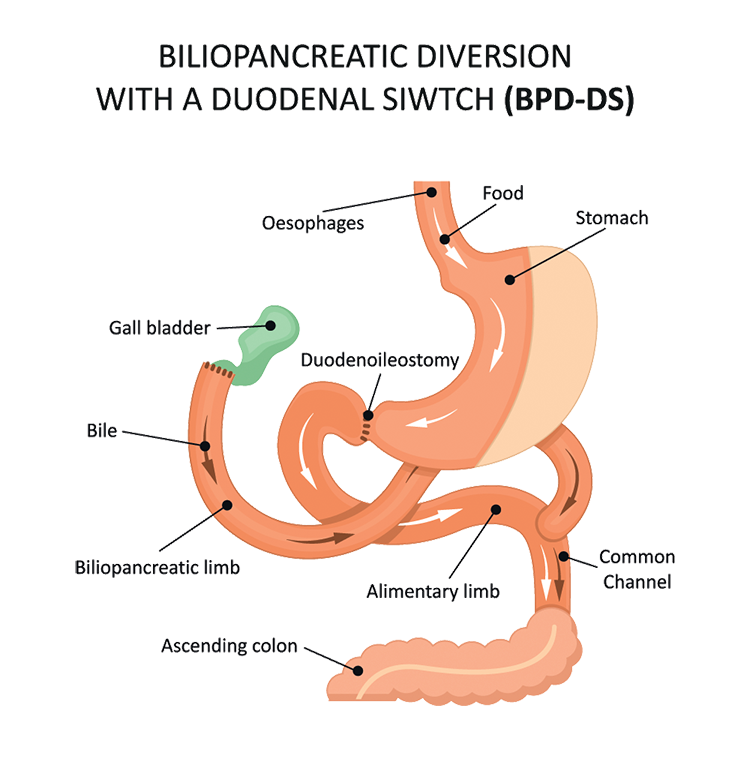 Image of how the SADI duodenal switch works