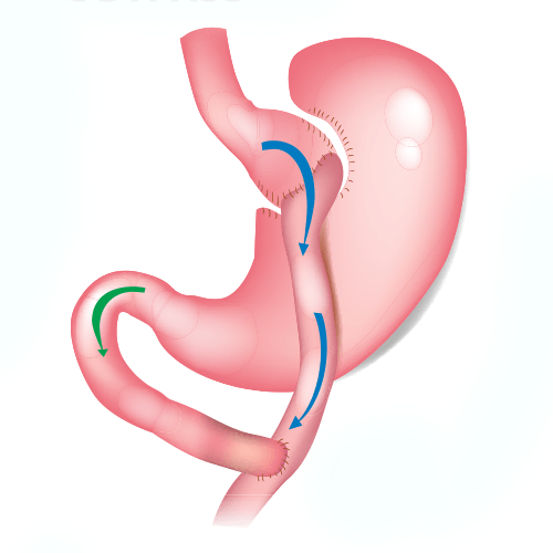 Image of a gastric bybass 