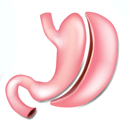 Image of a stomach that has been reduced in size